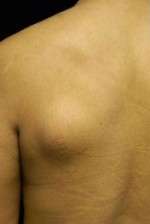 Minimal Incision and Power-assisted Liposuction Removal of Lipomas