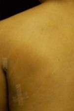 Minimal Incision and Power-assisted Liposuction Removal of Lipomas