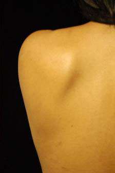Minimal Incision and Power-assisted Liposuction Removal of Lipomas