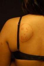 Minimal Incision and Power-assisted Liposuction Removal of Lipomas