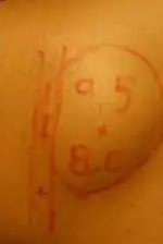 Minimal Incision and Power-assisted Liposuction Removal of Lipomas