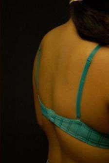 Minimal Incision and Power-assisted Liposuction Removal of Lipomas