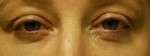 SmartSkin Wrinkle Removal-Fractional CO2