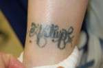 Tattoo Removal