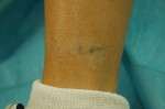 Tattoo Removal