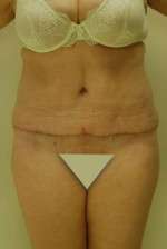 Abdominoplasty