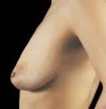 Mastopexy