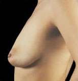 Mastopexy