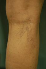 Laser Spider Vein Treatment