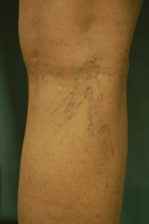 Laser Spider Vein Treatment