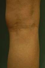 Laser Spider Vein Treatment