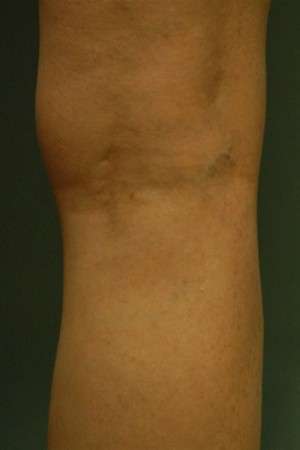 Laser Spider Vein Treatment
