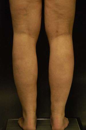 Smartlipo Triplex Laser Liposuction