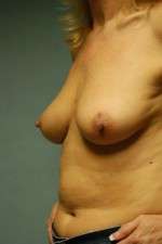 Breast Augmentation, Gel