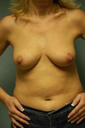 Breast Augmentation, Gel