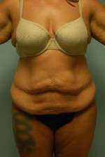 Abdominoplasty