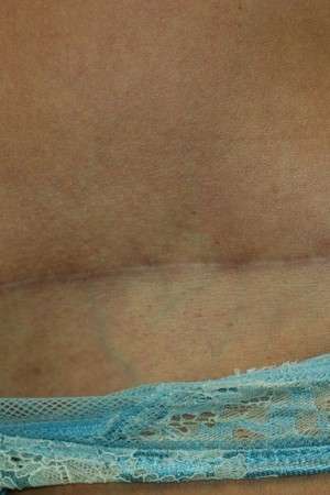 Abdominoplasty Case 3791 Before Photo Abdominoplasty