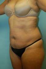 Abdominoplasty