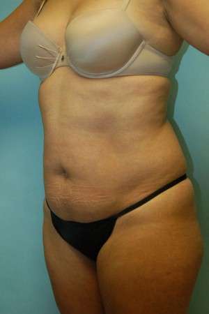 Abdominoplasty Case 3791 Before Photo Abdominoplasty