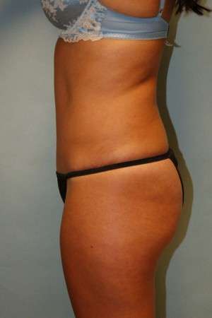 Abdominoplasty Case 3791 After Photo Abdominoplasty