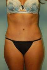Abdominoplasty
