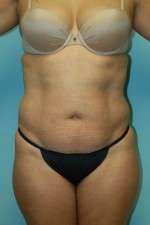 Abdominoplasty