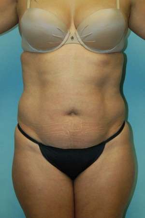 Abdominoplasty Case 3791 Before Photo Abdominoplasty