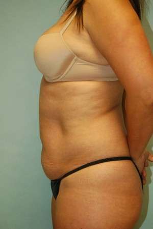 Abdominoplasty Case 3791 Before Photo Abdominoplasty