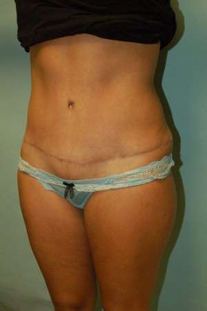Abdominoplasty Case 3791 After Photo Abdominoplasty