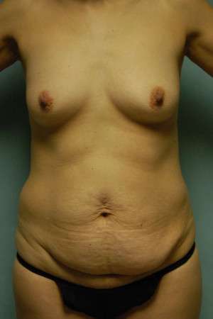 Abdominoplasty