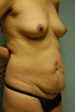 Abdominoplasty