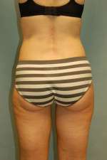 Liposculpture (Female)
