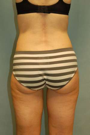 Liposculpture (Female)