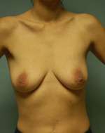 Breast Augmentation, Gel
