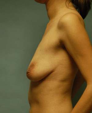 Breast Augmentation, Gel
