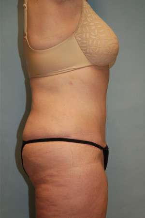 Abdominoplasty