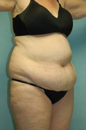 Abdominoplasty