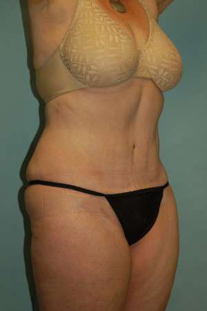 Abdominoplasty