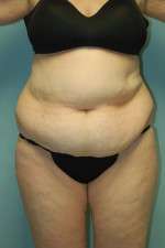 Abdominoplasty