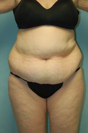 Abdominoplasty
