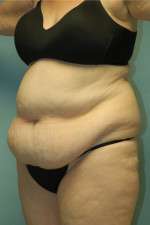 Abdominoplasty