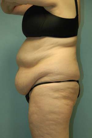 Abdominoplasty