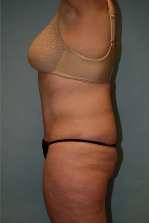 Abdominoplasty