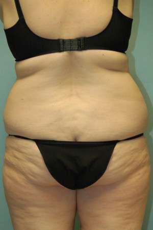 Abdominoplasty