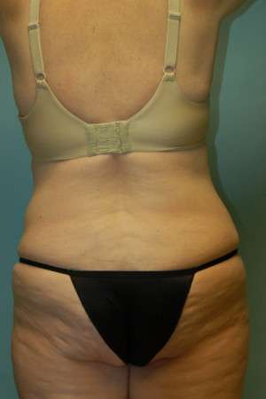 Abdominoplasty