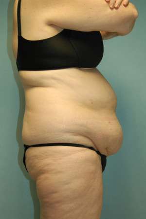 Abdominoplasty