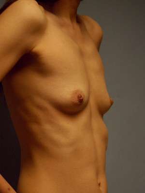Breast Augmentation, Gel