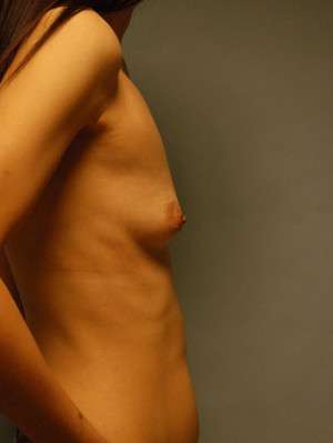 Breast Augmentation, Gel