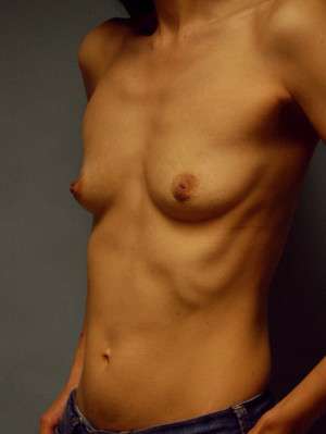 Breast Augmentation, Gel