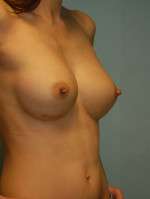 Breast Augmentation, Gel